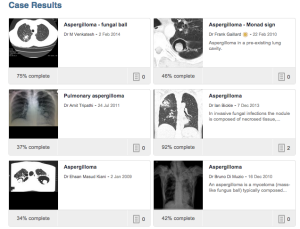 See Radiopedia for examples of aspergillomas: http://tinyurl.com/oljw24r